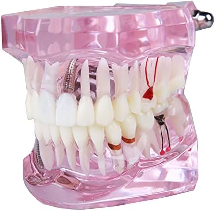 Modelo de dente patológico KH66ZKY - Modelo de dentes de doenças dentárias transparentes - Para ferramentas de ensino de dentes